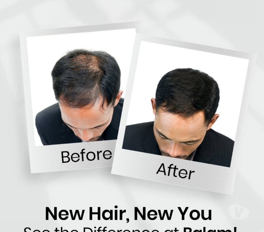 Other Services Bangalore - Photos for Bangalore - Bglam Hair Studio for all Non surgical Hair